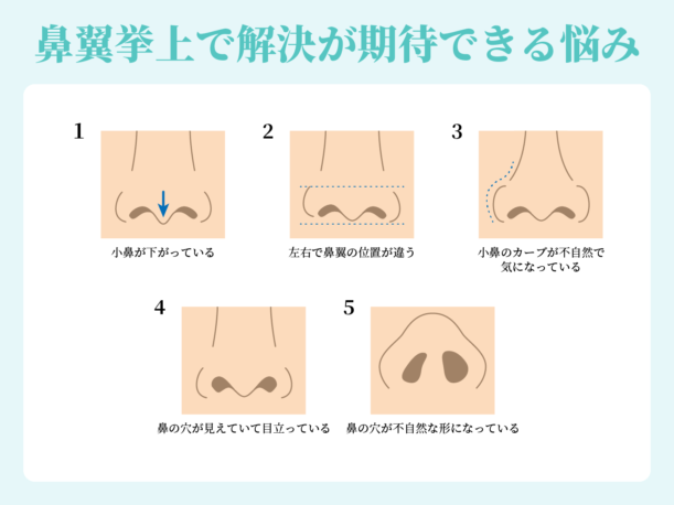 鼻翼挙上で解決が期待できる悩み