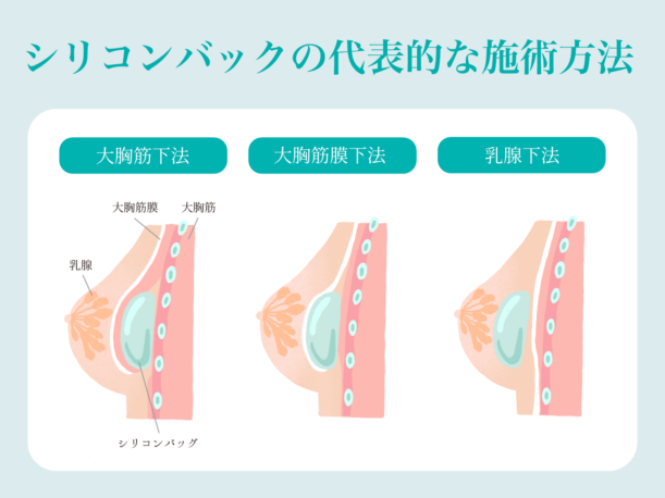 シリコンバックの代表的な施術方法