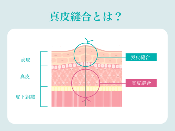 真皮縫合とは？